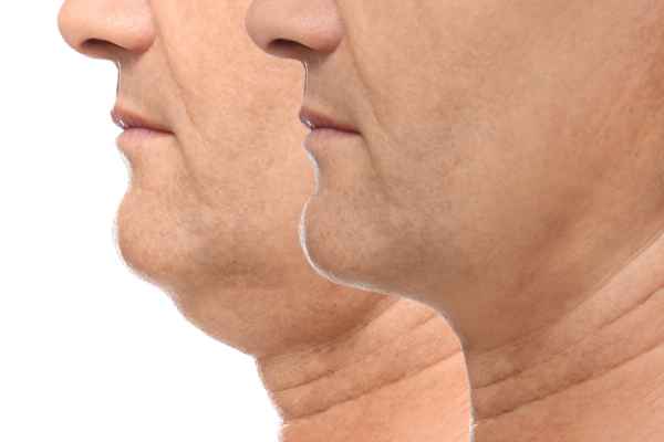 HIFU - Breakthrough in Anti - ageing 2 hifu results Witley