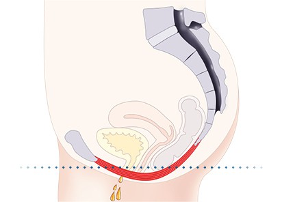 Pelvic-Floor Muscle Repair 5 Pelvic floor muscles Witley