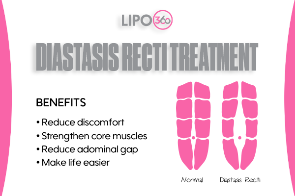 diastasis recti treatment Witley