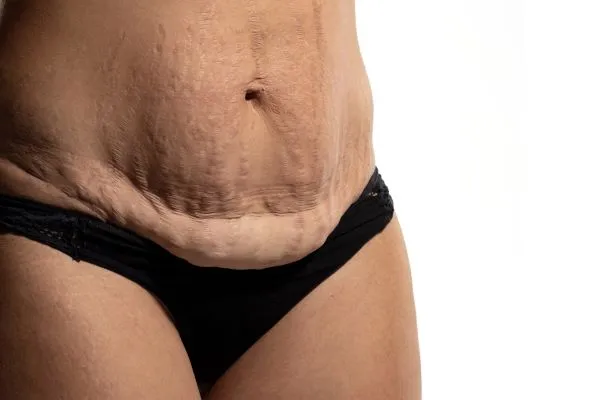 The Science of Skin Tightening 1 The science behind skin tightening Witley picture of a woman's sagging skin on the stomach